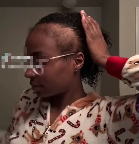 Vue de profil mettant en évidence une perte de cheveux et une alopécie localisée sur les tempes.
