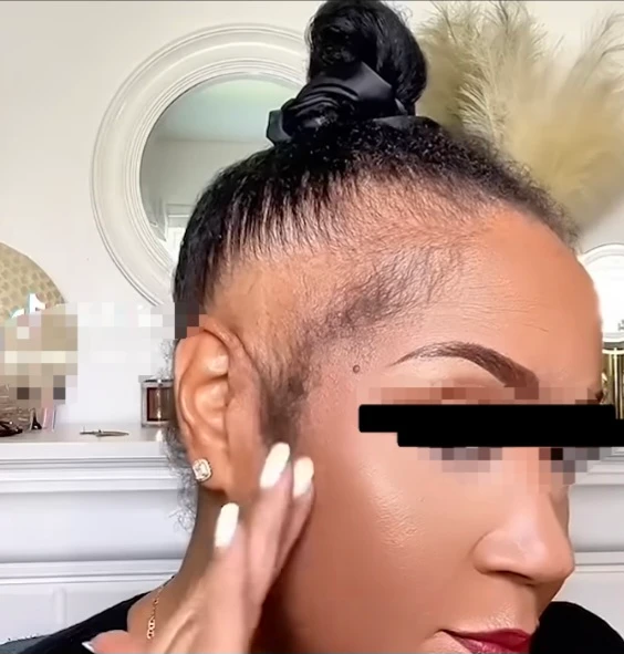 Cheveux naturels attachés en chignon montrant une zone de fragilité et d'alopécie de traction sur les tempes.